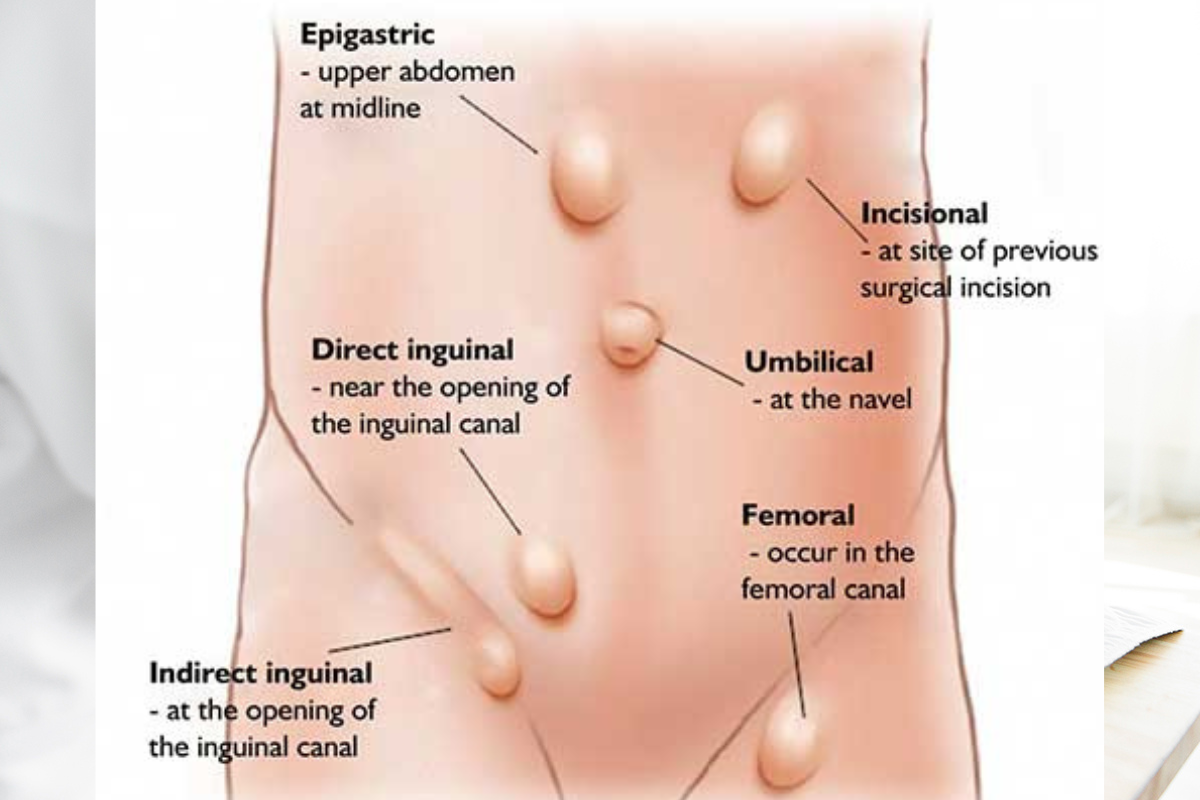 Laparoscopic Hernia Surgery